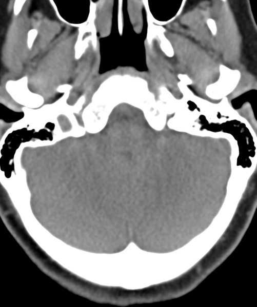 File:Normal cervical spine MRI (including Dixon) (Radiopaedia 42762-45926 Axial non-contrast 3).png