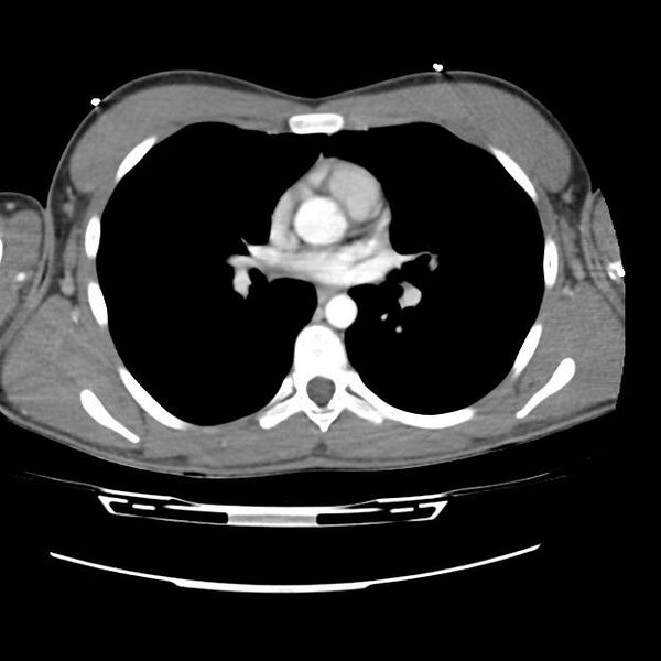File:Normal dual-phase trauma CT chest,abdomen and pelvis (Radiopaedia 48092-52899 A 27).jpg
