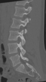 Normal lumbar spine CT (Radiopaedia 46533-50986 Sagittal bone window 42).png