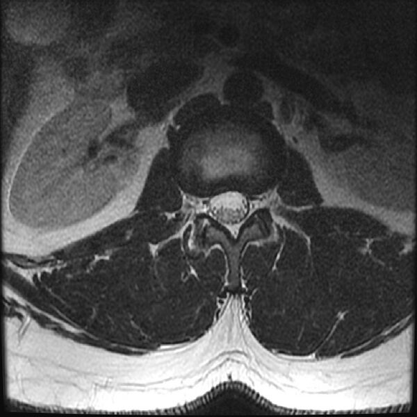 File:Normal lumbar spine MRI (Radiopaedia 43051-46311 Axial T2 3).jpg