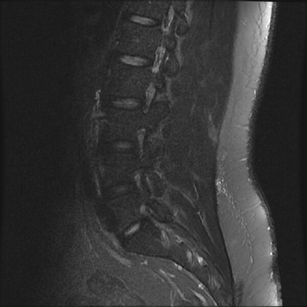 File:Normal lumbar spine MRI (Radiopaedia 43051-46311 Sagittal STIR 7).jpg
