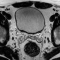 Normal prostate (MRI) (Radiopaedia 29986-30535 Axial T2 23).jpg