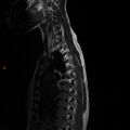 Normal spine MRI (Radiopaedia 77323-89408 E 3).jpg