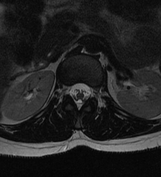 File:Normal thoracic spine MRI (Radiopaedia 41033-43781 Axial T2 33).jpg