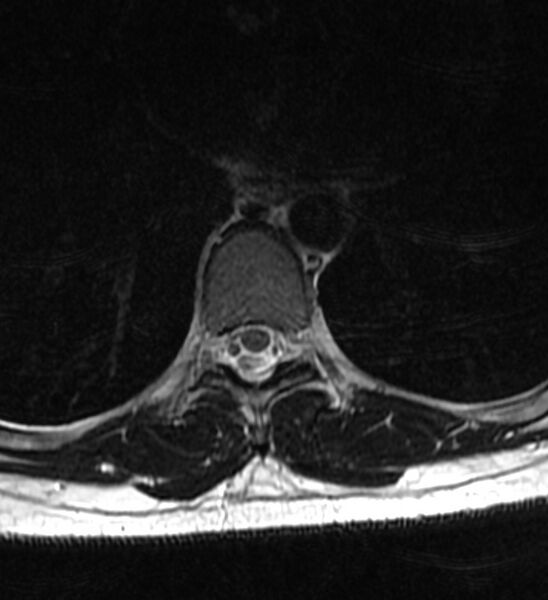 File:Normal thoracic spine MRI (Radiopaedia 41033-43781 Axial T2 6).jpg