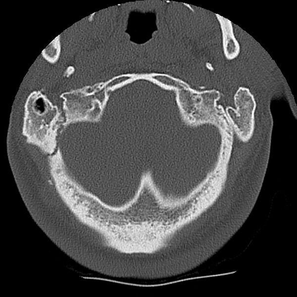 File:Normal trauma spine imaging (Radiopaedia 31753-32686 Axial bone window 1).jpg