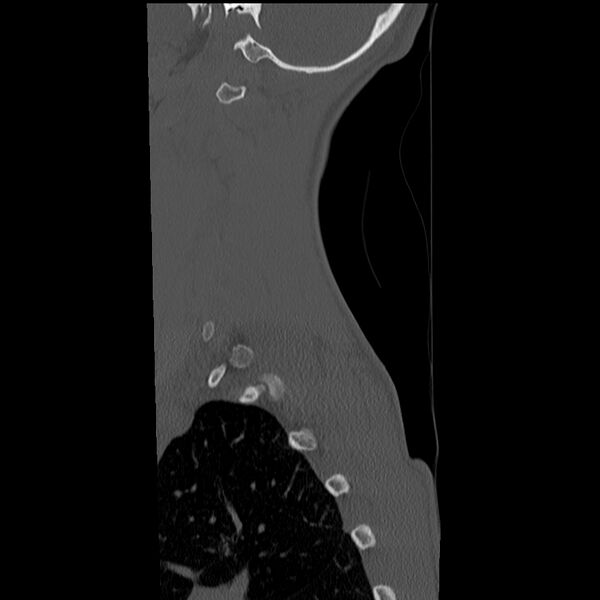 File:Normal trauma spine imaging (age 16) (Radiopaedia 45335-49358 Sagittal bone window 37).jpg