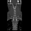 Occipital condyle fracture (Radiopaedia 31755-32691 Coronal bone window 22).jpg