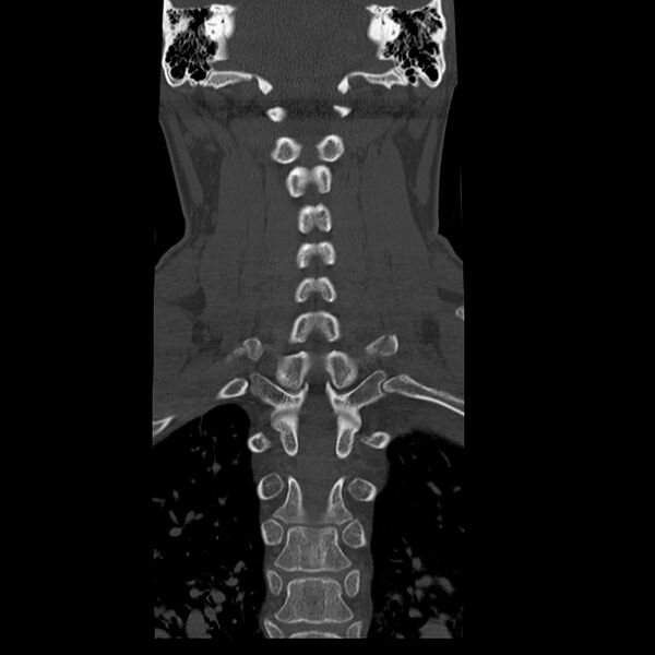 File:Occipital condyle fracture (Radiopaedia 31755-32691 Coronal bone window 22).jpg