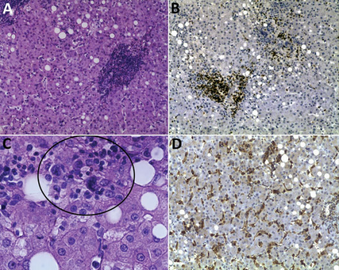 Image of liver biopsy sample from individual with (fatal) human monocytic ehrlichiosis