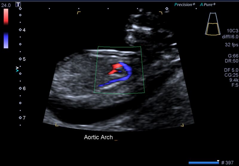 File:1st trimester nuchal-morphology ultrasound (Radiopaedia 44706-48477 General anatomy and NT 26).jpg
