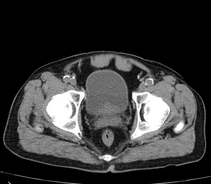 File:Abdominal aortic aneurysm (Radiopaedia 22421-22458 non-contrast 53).jpg