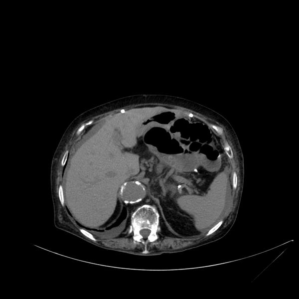 File:Abdominal aortic aneurysm - impending rupture (Radiopaedia 19233-19246 Axial non-contrast 32).jpg