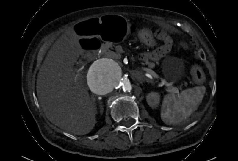File:Abdominal aortic aneurysm with thrombus fissuration (Radiopaedia 73192-83919 Axial C+ arterial phase 43).jpg