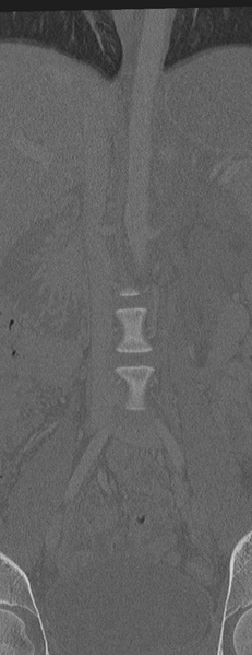 File:Abdominal multi-trauma - devascularised kidney and liver, spleen and pancreatic lacerations (Radiopaedia 34984-36486 Coronal bone window 14).png