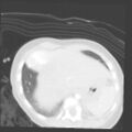 Aberrant left pulmonary artery (pulmonary sling) (Radiopaedia 42323-45435 Axial lung window 34).jpg