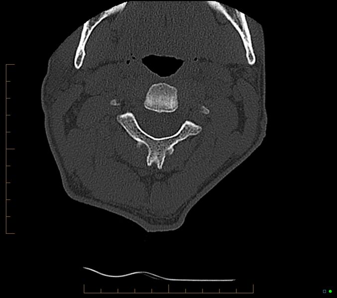 File:Accessory articulation of cervical transverse processes (Radiopaedia 82715-96933 Axial non-contrast 41).jpg