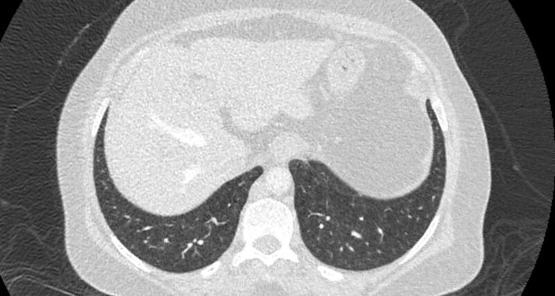 File:Accessory right inferior hepatic vein (Radiopaedia 65245-74259 Axial lung window 66).jpg