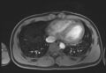 Active right ventricular cardiac sarcoidosis (Radiopaedia 55596-62100 Axial Post contrast Dixon 56).jpg