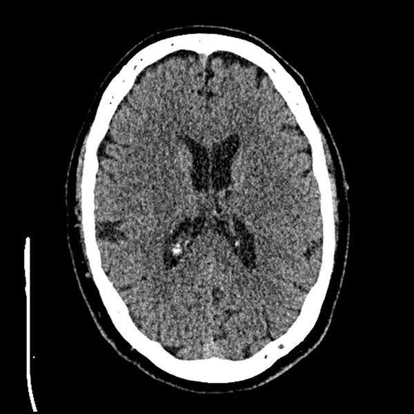 File:Acute A3 occlusion with ACA ischemic penumbra (CT perfusion) (Radiopaedia 72036-82525 Axial non-contrast thins 54).jpg
