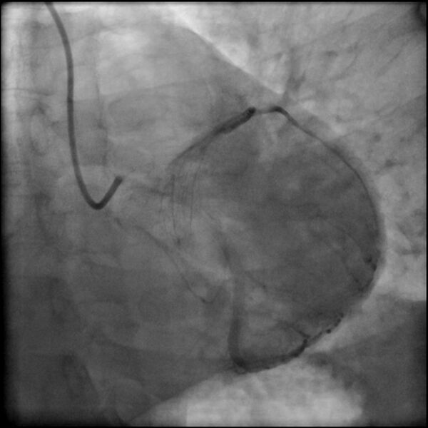 File:Acute anteroseptal myocardial infarction (Radiopaedia 68409-77946 LAO caudal (spider view) LAD and CX 58).jpg