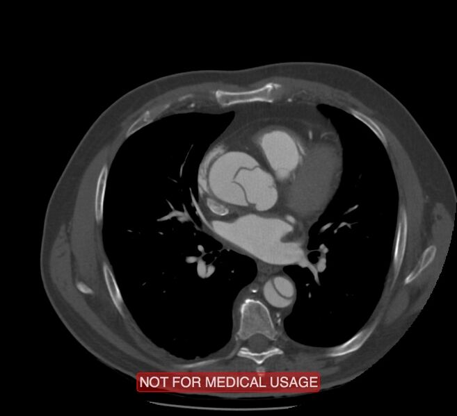 File:Acute aortic dissection - Stanford type A (Radiopaedia 40661-43285 Axial C+ arterial phase 35).jpg