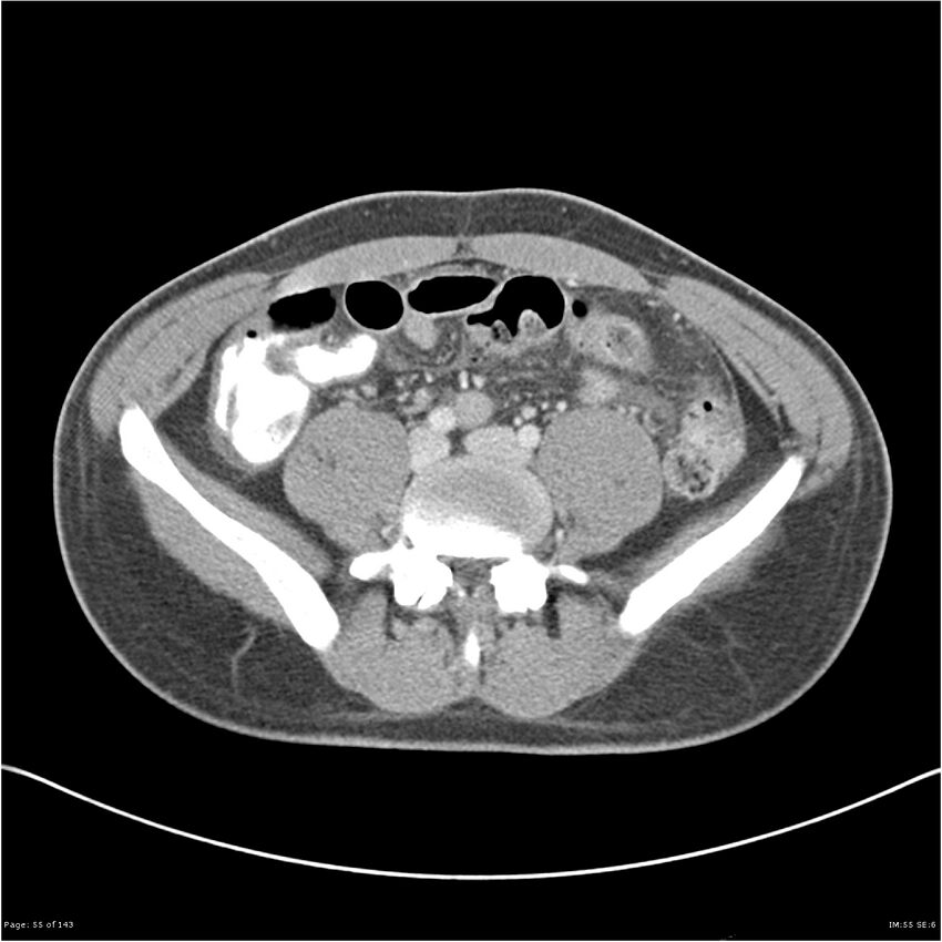 Acute appendicitis (Radiopaedia 25364-25615 B 45).jpg