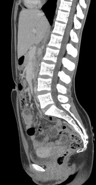 File:Acute appendicitis (Radiopaedia 62608-70901 Sagittal C+ portal venous phase 19).jpg