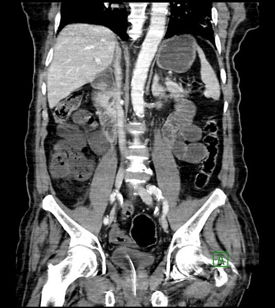 File:Acute arterial mesenteric ischemia (Radiopaedia 78238-90828 Coronal C+ portal venous phase 55).jpg