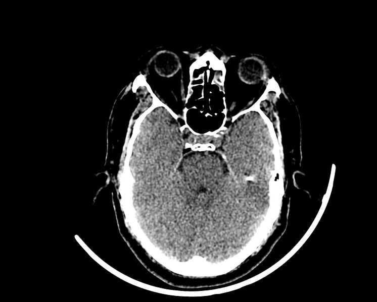 File:Acute cerebral infarct (Radiopaedia 35604-37123 Axial non-contrast 31).jpg
