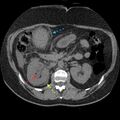 Acute cholecystitis and ureteric colic (Radiopaedia 42330-45446 Figure 1 1).jpg