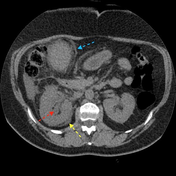 File:Acute cholecystitis and ureteric colic (Radiopaedia 42330-45446 Figure 1 1).jpg
