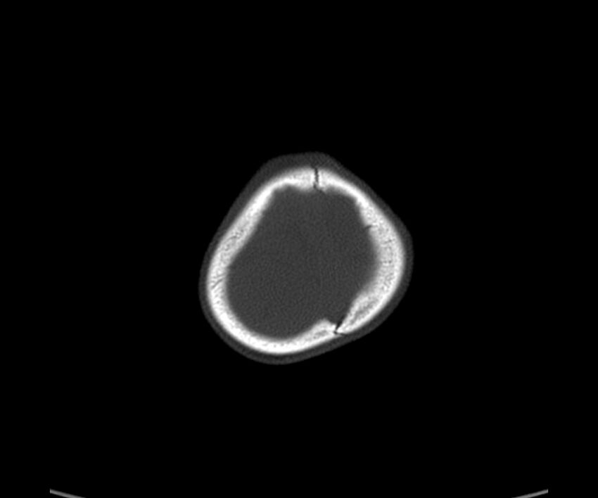 Acute hemorrhagic contusion (Radiopaedia 63660-72336 Axial bone window 62).jpg