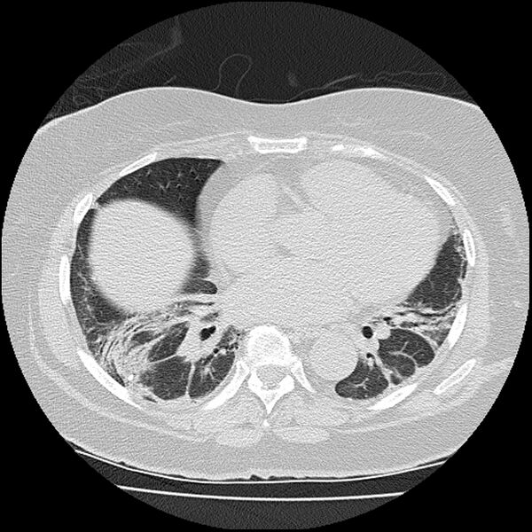 File:Acute interstitial pneumonitis (Radiopaedia 45404-49452 Axial lung window 57).jpg
