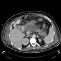 Acute pancreatic necrosis (Radiopaedia 13560-18503 Axial C+ portal venous phase 23).jpg