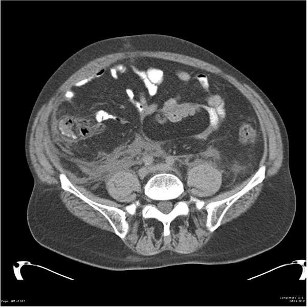File:Acute pancreatitis (Radiopaedia 19135-19116 Axial non-contrast 42).jpg