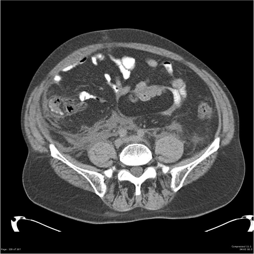 Acute pancreatitis (Radiopaedia 19135-19116 Axial non-contrast 42).jpg