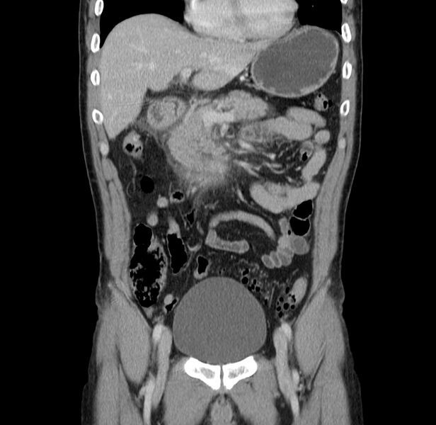 File:Acute pancreatitis (Radiopaedia 22572-22596 Coronal C+ portal venous phase 20).jpg