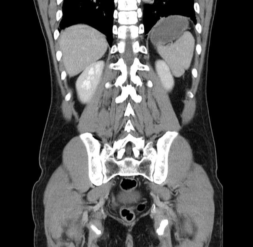 Acute pancreatitis (Radiopaedia 22572-22596 Coronal C+ portal venous phase 42).jpg