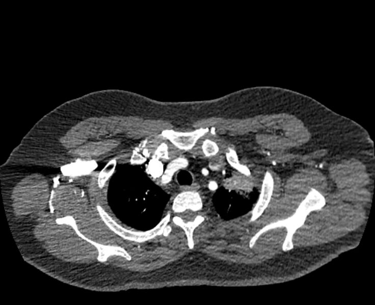 File:Acute pulmonary embolism with pulmonary infarcts (Radiopaedia 77688-89908 Axial C+ CTPA 5).jpg