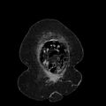 Acute pyelonephritis (Radiopaedia 25657-25837 Coronal renal parenchymal phase 14).jpg