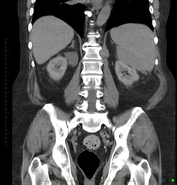 File:Acute renal failure post IV contrast injection- CT findings (Radiopaedia 47815-52557 Coronal non-contrast 33).jpg
