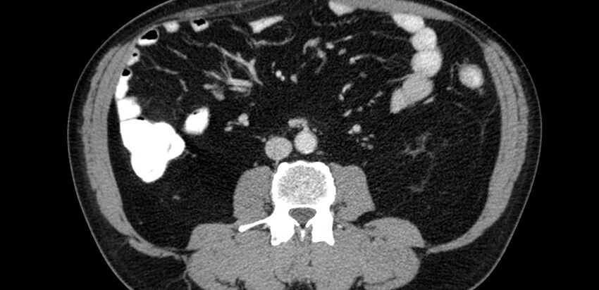 Acute sigmoid colon diverticulitis (Radiopaedia 55507-61976 Axial C+ portal venous phase 22).jpg