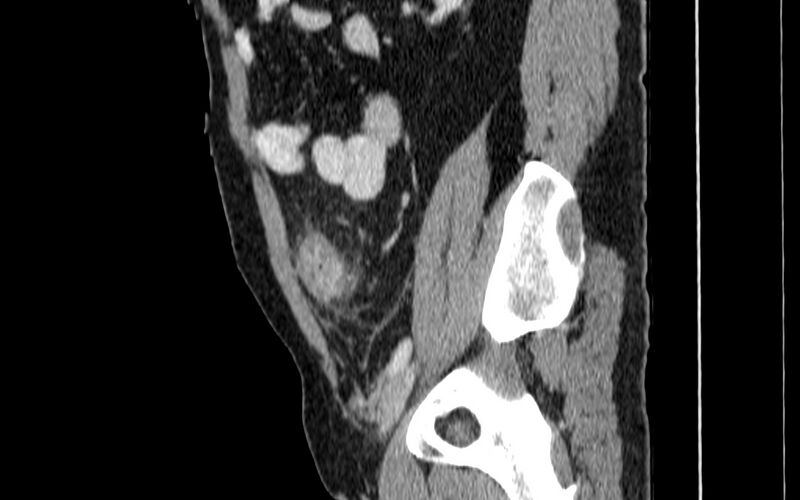 File:Acute sigmoid colon diverticulitis (Radiopaedia 55507-61976 Sagittal C+ portal venous phase 70).jpg