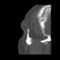 Acute sinusitis (Radiopaedia 23161-23215 Sagittal bone window 5).jpg