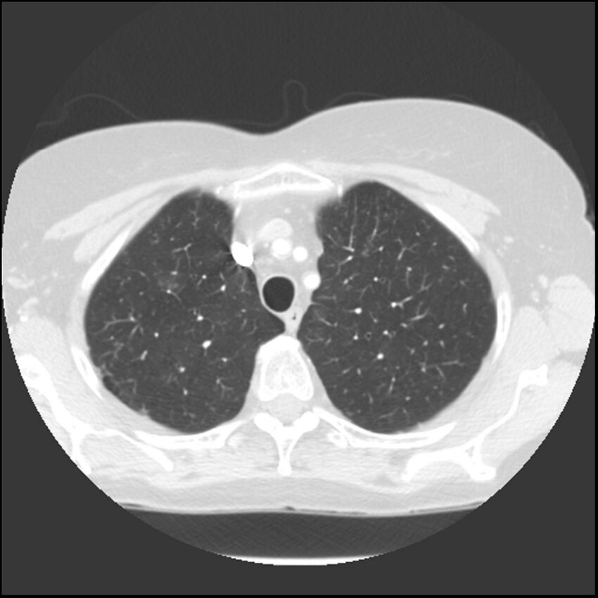 Adenocarcinoma of the lung (Radiopaedia 41015-43755 Axial lung window 26).jpg