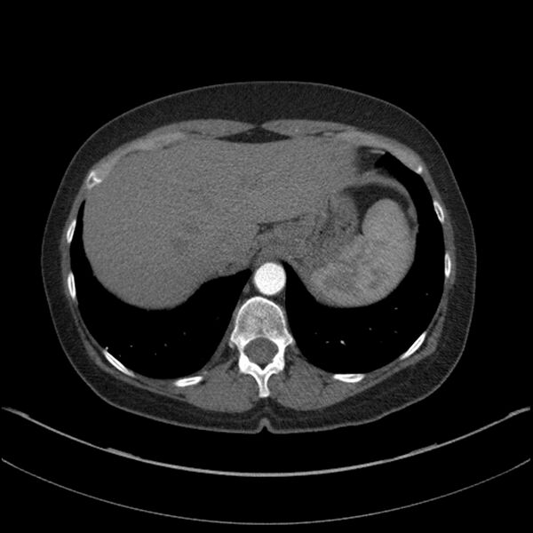 File:Adenocarcinoma of the lung (Radiopaedia 44205-47803 Axial C+ portal venous phase 73).jpg