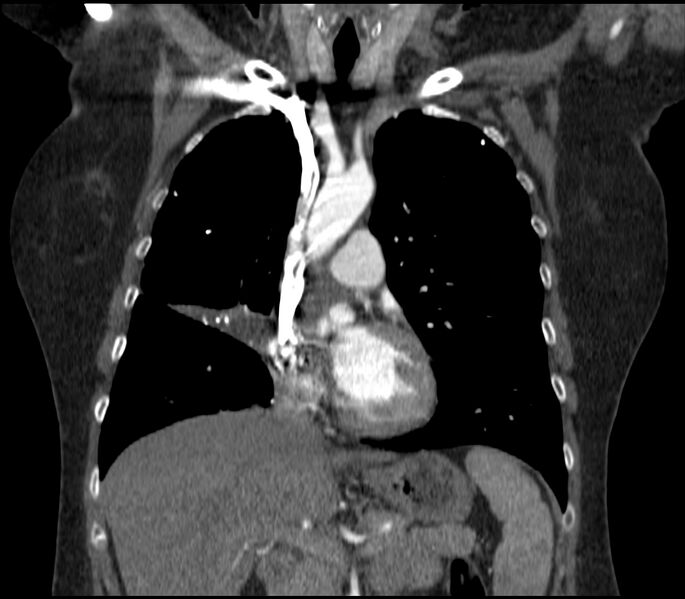 File:Adenocarcinoma of the lung (Radiopaedia 44205-47803 Coronal C+ portal venous phase 35).jpg