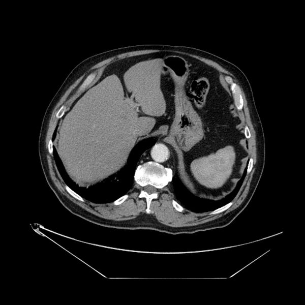 File:Adenocarcinoma of the lung (Radiopaedia 44876-48759 Axial C+ portal venous phase 75).jpg