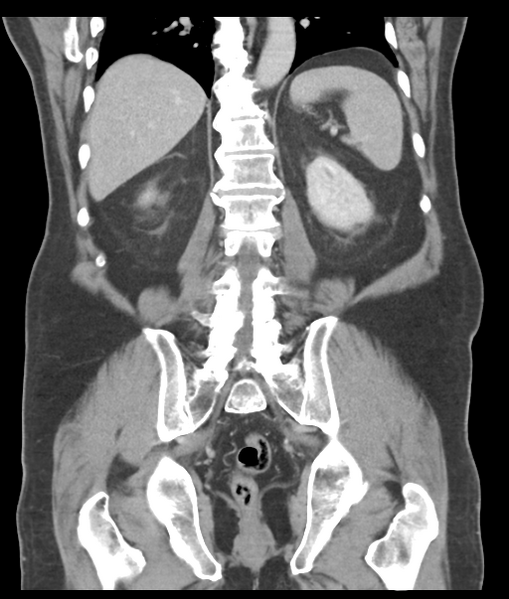 File:Adenocarcioma of rectum- T1 lesion (Radiopaedia 36921-38547 Coronal C+ portal venous phase 45).png